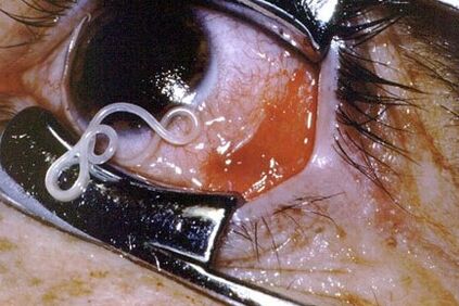 Worms in the eyes of a man